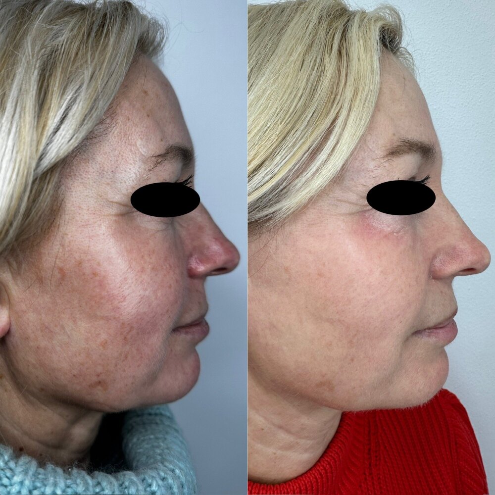 Gesicht einer Patientin vor und nach der Entfernung von Altersflecken mit IPL