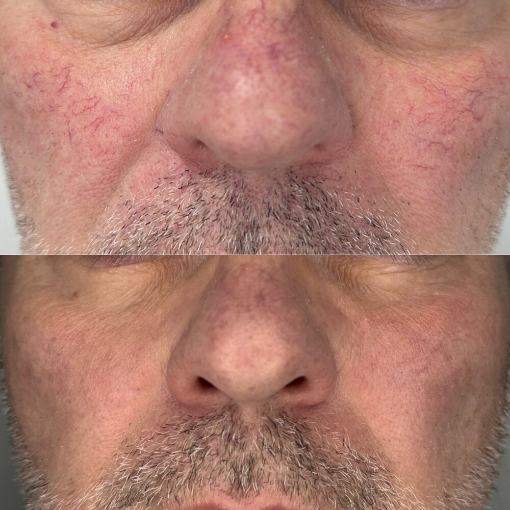 Nase und Wangen vor und nach einer Rosacea-Behandlung mit IPL