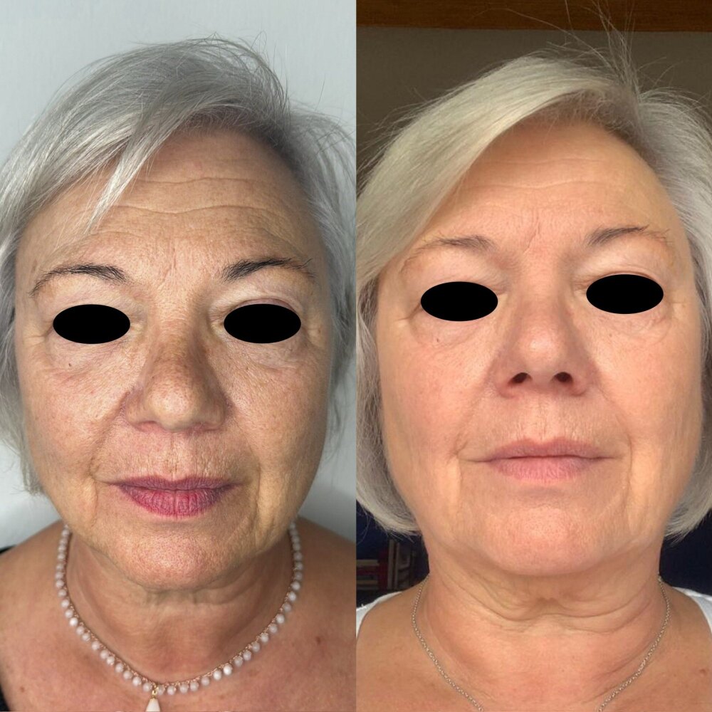 Wange einer Patientin vor und nach der Entfernung von Altersflecken mit IPL