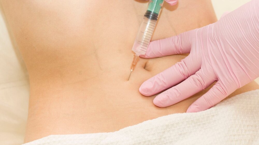 Injektion zur Fettreduktion am Bauch