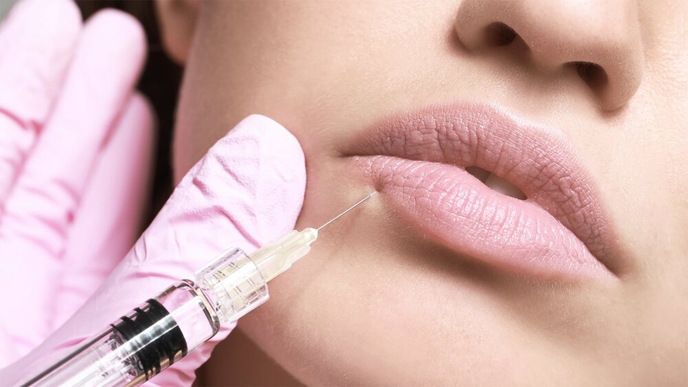 Lippenbehandlung mit Hyaluronsäure