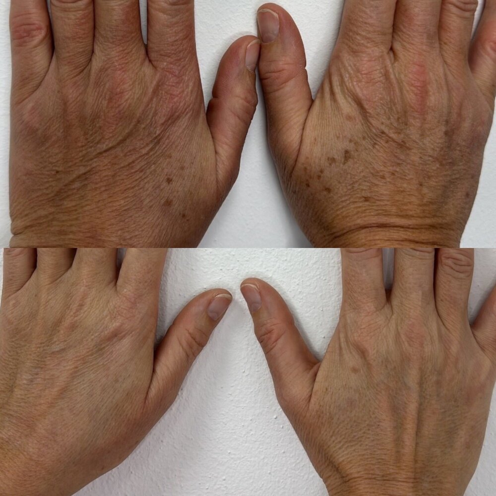 Handrücken vor und nach der Entfernung von Altersflecken mit IPL